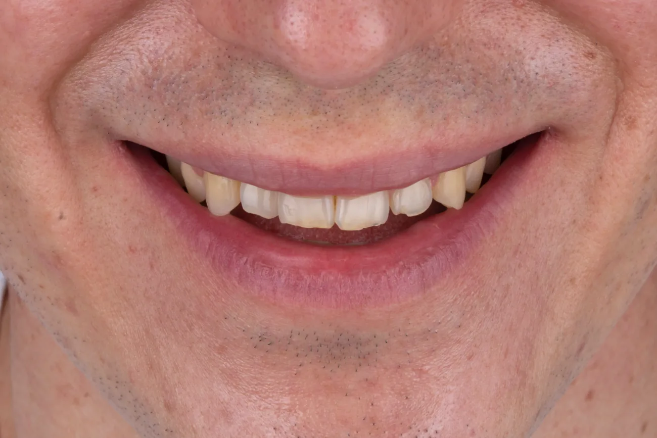 Antes