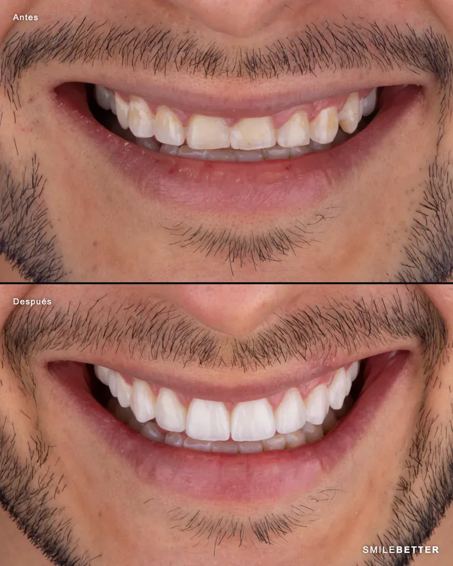 Caso 12 de 14 · antes y después con carillas LDP®