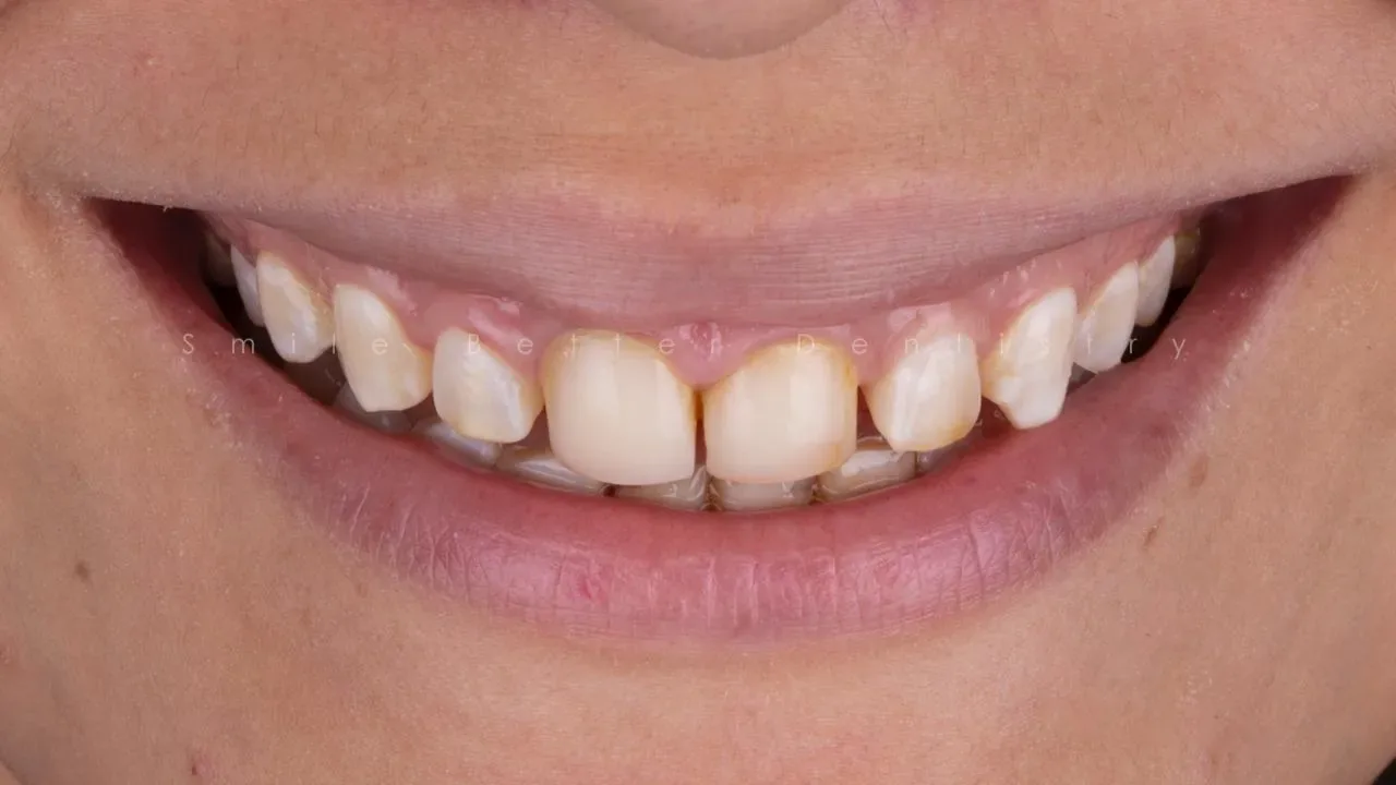 Antes